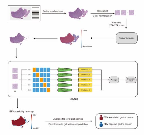 人工智能助力胃癌分子分型 中肿蔡木炎团队取得研究新进展